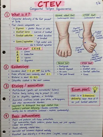 Congenital Talipes Equinovarus (CTEV) - clubfoot preview