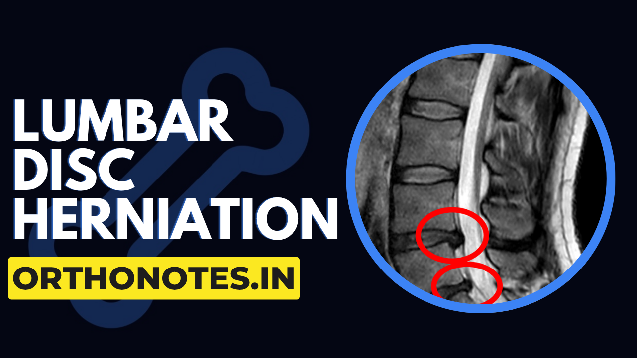 Lumbar Disc Herniation Explained | Diagnosis & Management Made Simple (Ortho Guide)