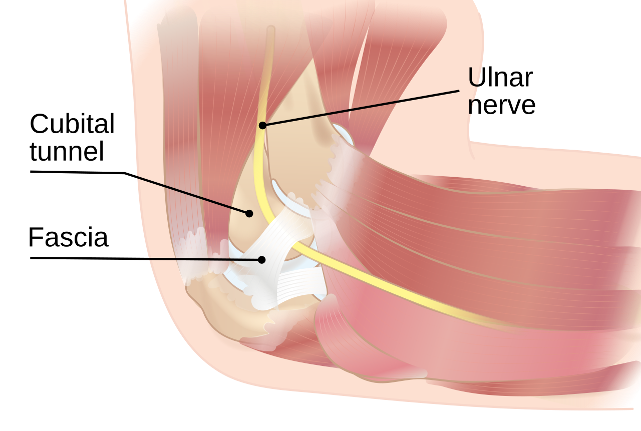 Cubital Tunnel Syndrome - Entrapment Neuropathy