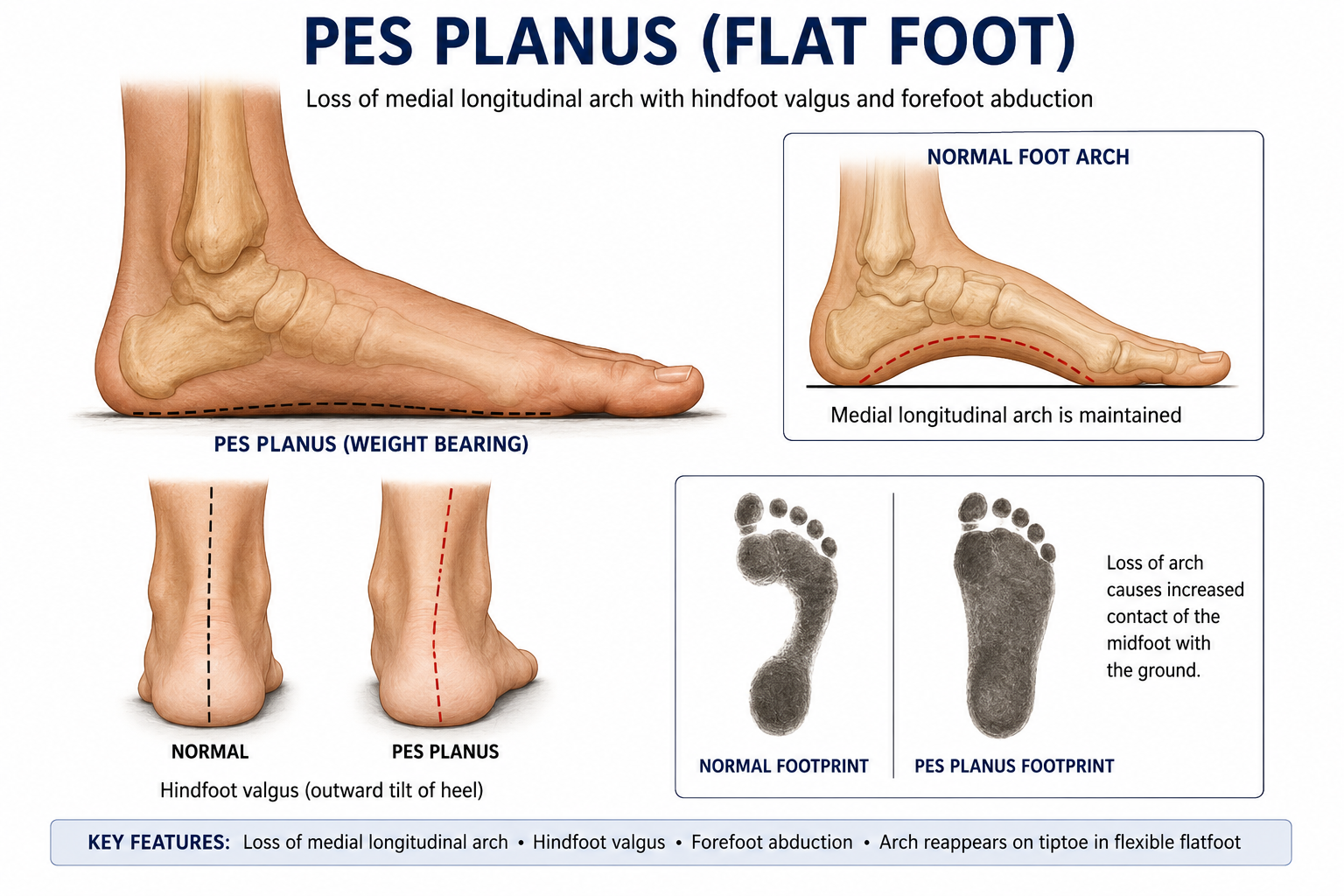 Pes Planus - Flat foot
