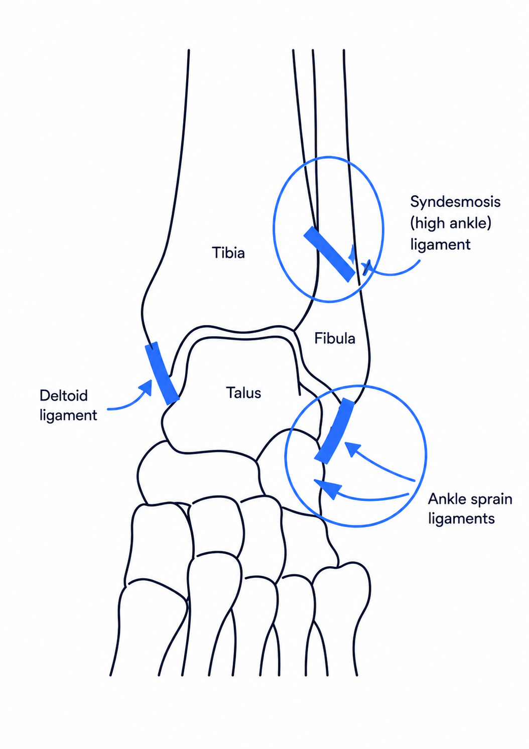 Syndesmotic Injuries - Assessment and Fixation Choices